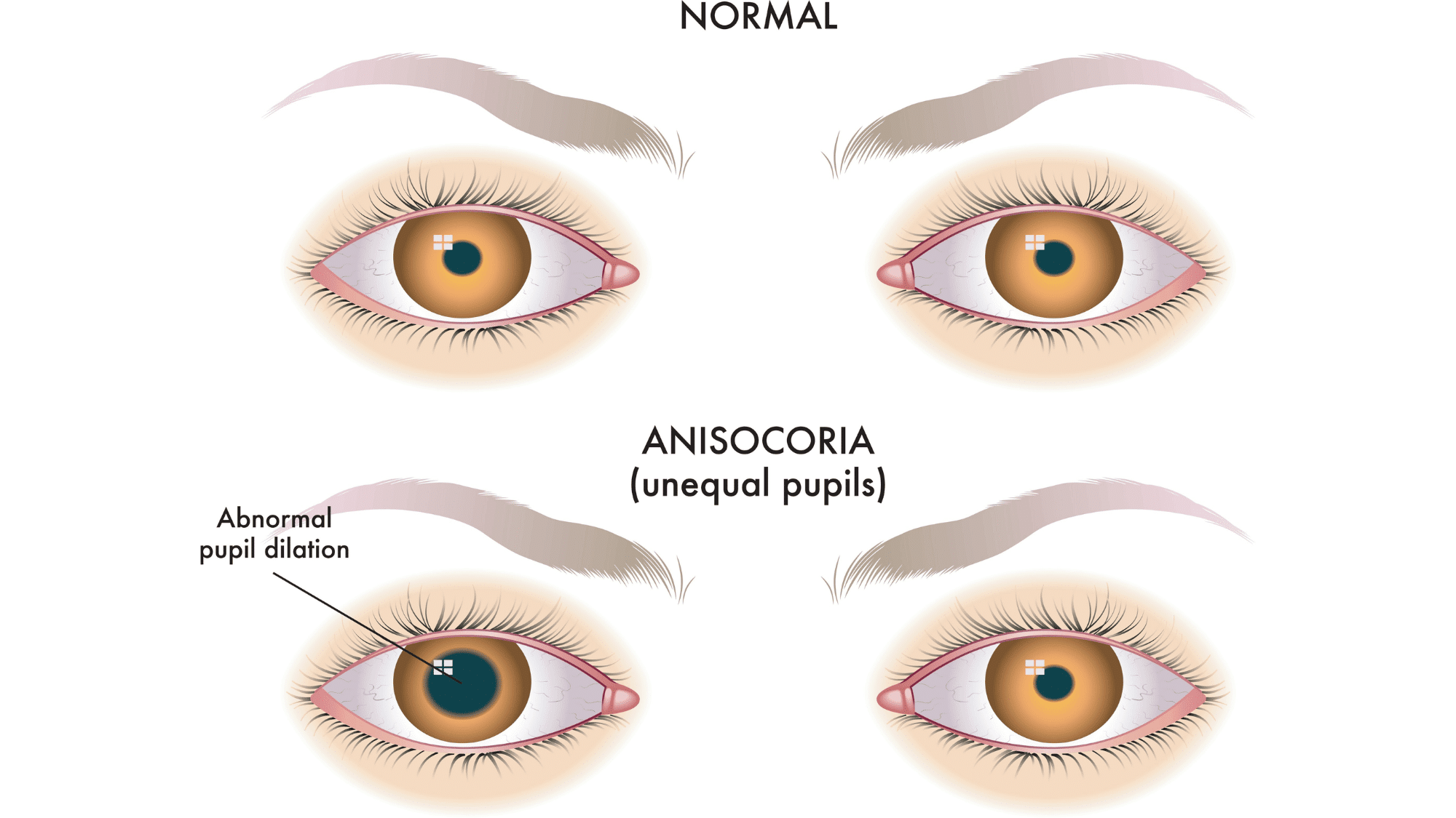 David Bowie Eyes Condition