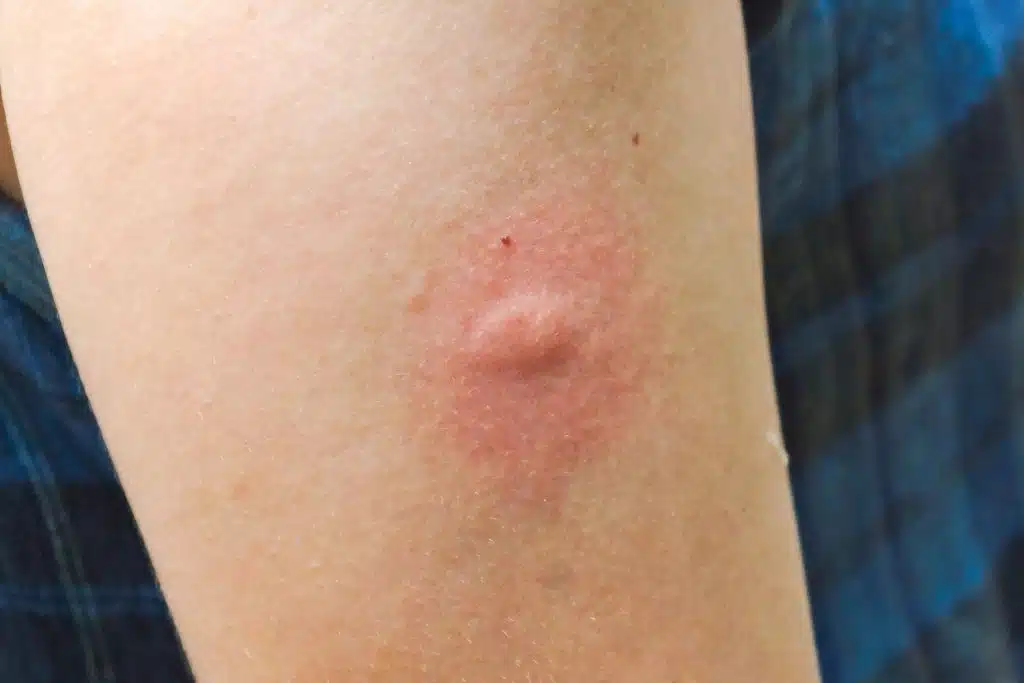 Close-up of a red inflamed mosquito bite welt on light-colored skin encouraging applying homemade mosquito repellent to it